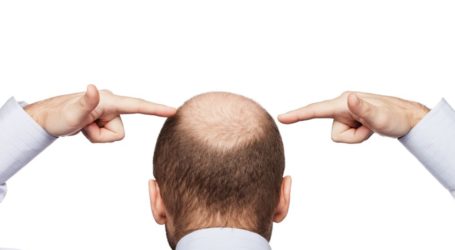 ¿Qué es la alopecia y qué la causa? Según Capilea Monterrey
