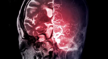 Estimulación cerebral profunda es alentadora para pacientes con accidente cerebrovascular: Cleveland Clinic